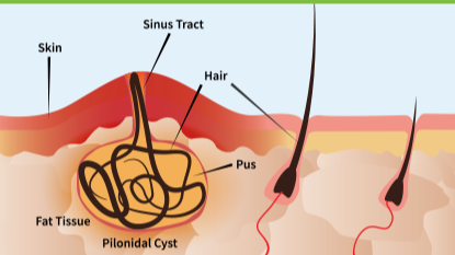 Pilonidal Treatment Center of New Jersey