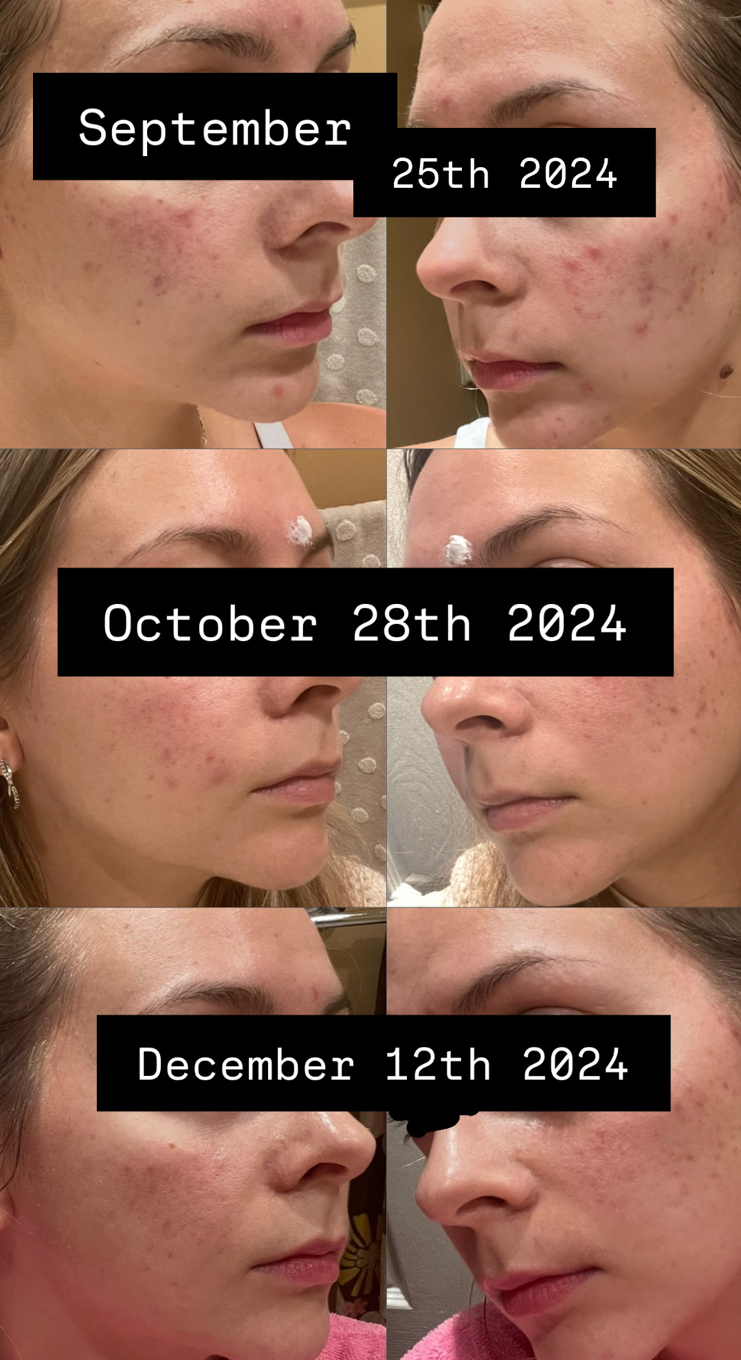 Skincare routine for the girlies with hormonal acne/sensitive skin cover photo collage